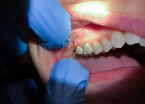 Best Emergency Dentist for Lost Fillings or Crowns in Four Corners, MT